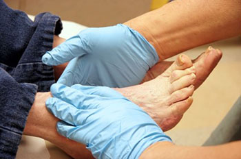 Diabetic foot treatment in the Hanover, PA area