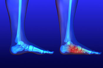 Flat feet treatment in the Hanover, PA area
