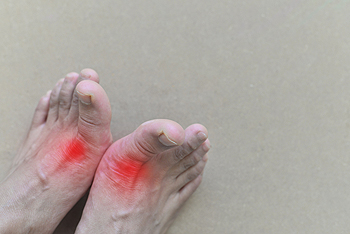 Gout Treatment in the Hanover, PA area