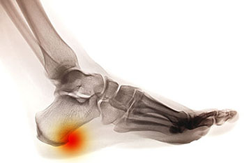 Heel spur treatment in the Hanover, PA area