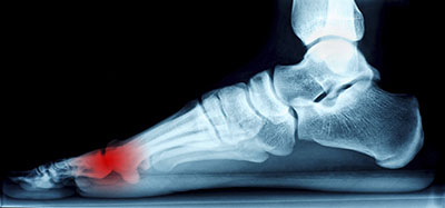 Neuromas Treatment in the Hanover, PA area