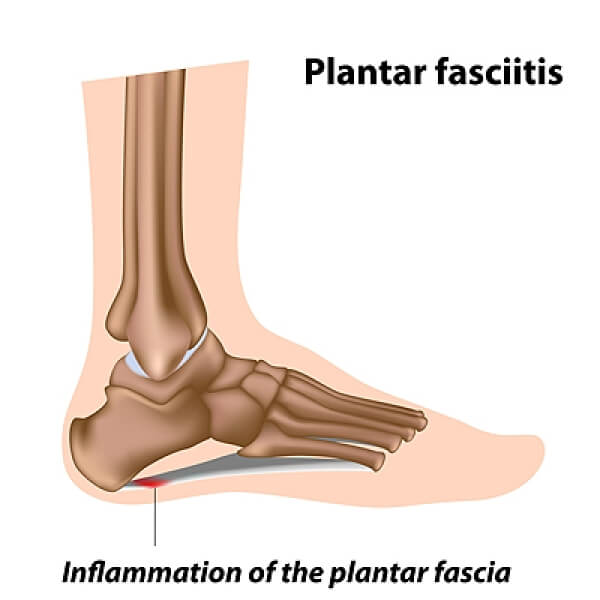 How to Relieve Plantar Fasciitis Pain Using Pressure Points - Custom  Orthotics Blog - Upstep
