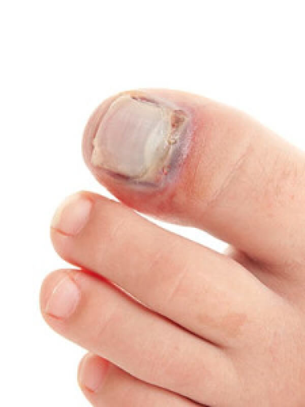 Possible Causes Of Broken Toes